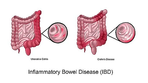 An autoimmune disease like IBD, which includes ulcerative colitis and Crohn's disease, currently affects one in ten persons in the UK and about 5% of the global population. (Representational image: Wikimedia Commons)