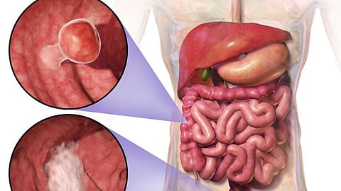 Facilities accredited by the American College of Surgeons National Accreditation Program for Rectal Cancer have lower mortality and complication rates for rectal cancer surgery (Representational Image: Wikimedia Commons)