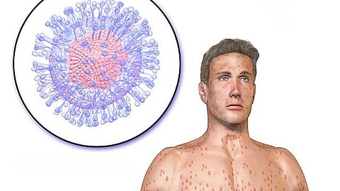 Chickenpox symptoms typically manifest 10 to 21 days after exposure to the virus. (Representational image: Wikimedia commons)