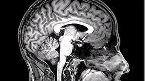 Neuroimaging disclosed multiple cysts on both sides of his brain, which later turned out to be pork tapeworm eggs. (Representational Image: Wikimedia Commons)
