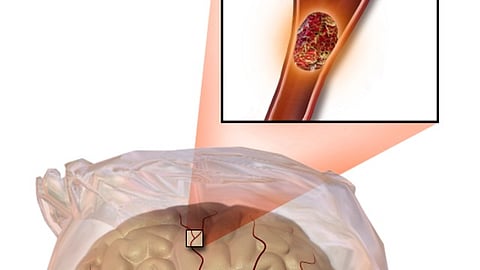 For people with stroke, social factors such as education, neighborhood and employment may be linked to whether they receive treatment with clot-busting drugs. (Representational Image: Wikimedia Commons)