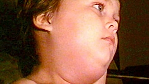 Swelling and tenderness of the salivary glands, especially the parotid glands near the jawline, is the hallmark symptom. (Representational Image: Wikimedia Commons)