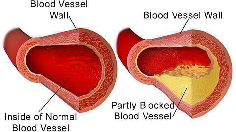 The goal in taking statins is to lower your risks for cardiovascular problems like heart attacks, clogged arteries and strokes. (Wikimedia Commons)