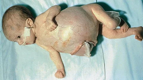 In high-risk neuroblastoma, inhibiting KDM4 demonstrated strong anticancer activity by blocking MYCN expression. (Representational image: Wikimedia Commons)