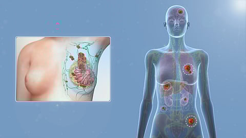 Breast cancer is the most common malignancy in women, posing a serious threat to the female health. (Wikimedia Commons)
