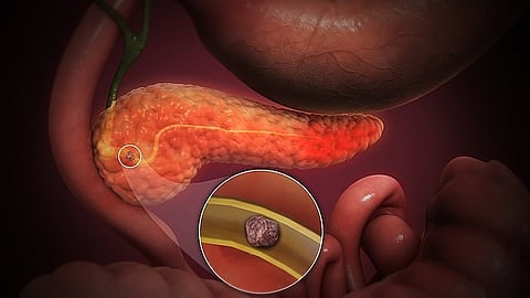 A research study recently published explains the role of pancreatic enzyme therapy (PERT) in reducing the frequency of acute pancreatitis (Representational Image: Wikimedia Commons)