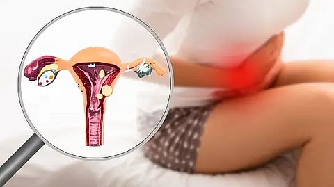 Cedars-Sinai experts find endometriosis patients can now benefit from minimally invasive procedures, medications and integrative medicine.
(Representational Image: Unsplash)
