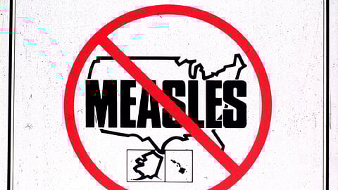 Decades after the highly effective measles vaccine stopped the continuous spread of the virus (Representational image: Wikimedia)