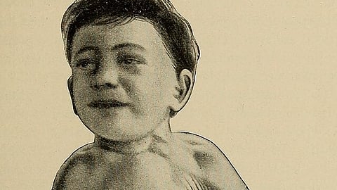 Researchers pointed to already worrying signs, saying that reduction in under-5 deaths has slowed at the global level (Representational Image: Wikimedia Commons)