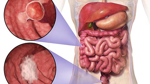 Colorectal cancer screening is now recommended for patients of average risk—meaning no personal or family history of the disease, among other factors—beginning at age 45.