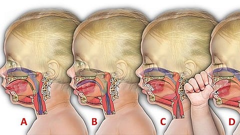 The challenges posed by Pierre Robin syndrome extend beyond physical limitations. (Representational image: Wikimedia commons)