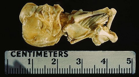 In abdominal ectopic pregnancy the fetus may survive for an extended period before dying and undergoing calcification, resulting in lithopedion formation.
(Representational image: Wikimedia commons)