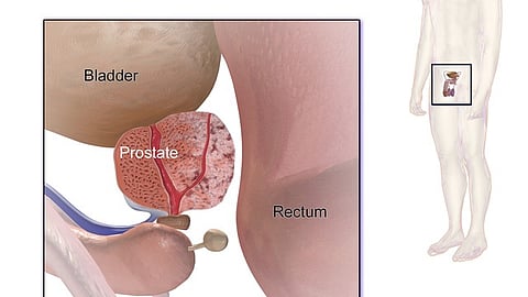 Prostate cancer (Wikimedia Commons)
