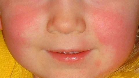 Scarlet fever was previously a fatal threat, but advances in antibiotic treatment have made it less deadly, especially among children under the age of ten, who are the most vulnerable to the disease. (Representational image: Wikimedia commons)