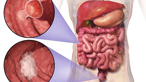 Physicians have long been concerned about the potential for a missed Colorectal Cancer (CRC) in patients presenting with presumed diverticulitis, but research now shows that the risk of CRC is low in most patients with the disease.
(Representational Image: Wikimedia commons)