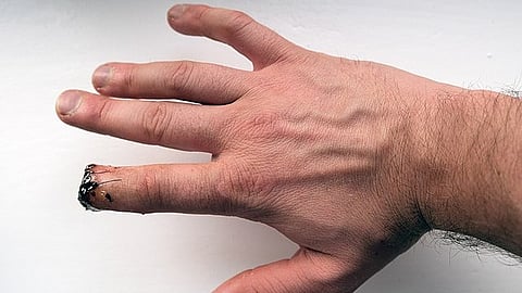 The importance of the index finger cannot be pointed out, as it plays an important role in numerous daily activities and is required for maintaining a high level of flexibility. (Representational image: Wikimedia commons)
