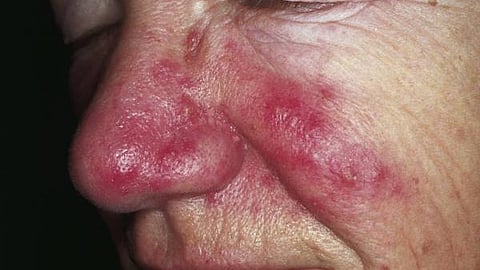 Erythema and telangiectasia are seen over the cheeks, nasolabial area and nose. Inflammatory papules and pustules can be observed over the nose. The absence of comedos is a helpful tool to distinguish rosacea from acne. (Wikipedia Commons)