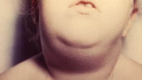 According to government data, the cumulative count of mumps cases had reached 15,637 by March 2024
(Representational image: Wikimedia commons)