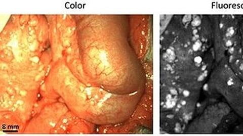 Ovarian cancer (Wikimedia Commons)