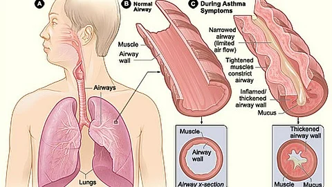 As we mark World Asthma Day this May, it's crucial to shed light on a lesser-known aspect of asthma care: dental health. (Wikimedia Commons)