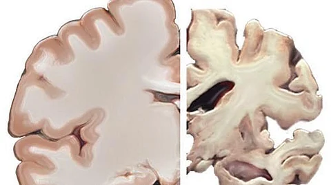 The grant from the Alzheimer's Association will help fund the clinical development of NTRX-07, which has shown promising results in preclinical studies. (Representation Image: Wikimedia Commons)