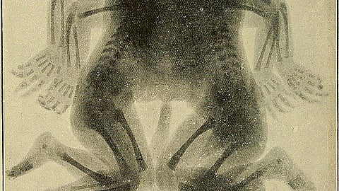Ischiopagus twins, where the connection is at the pelvis, account for only six to eleven percent of conjoined twin cases.
(Representational image: Wikimedia commons)