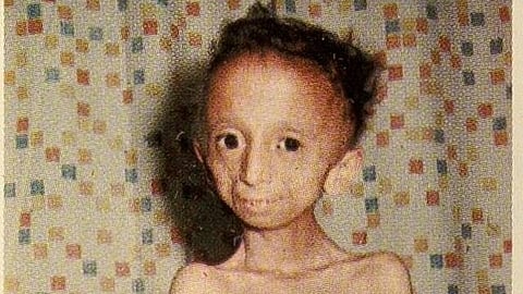 Progeria rare genetic disorder characterized by accelerated aging in children (Wikimedia Commons)
