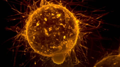 A breast cancer cell line panel and primary tumor explants from breast and cervical cancer patients to examine two different cellular contractility modes. (Representational Image: Unsplash)