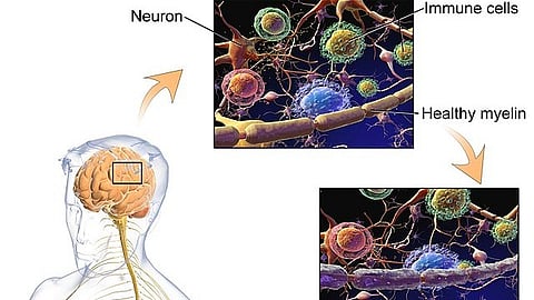 Researchers found that Multiple sclerosis patient derived spontaneous B cells have distinct EBV and host gene expression profiles in active disease.