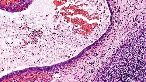 Endometriosis affects 1 in 9 women and those assigned female at birth. However, it takes 6.4 years to diagnose using the conventional standard of surgical laparoscopy.(Representational Image: Wikimedia Commons)