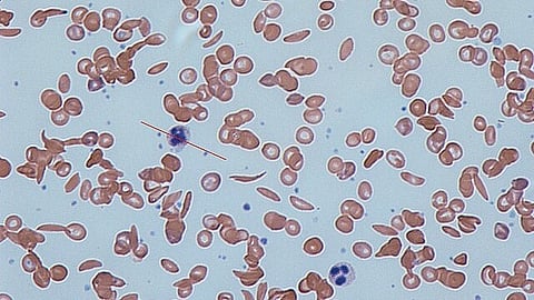Novel Gene-editing therapy continues to show positive results in sickle cell disease patients (Representational image-Wikimedia Commons)