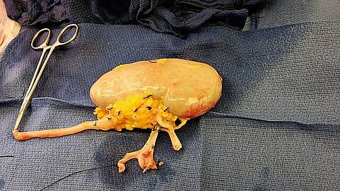 Study reveals unexpected mechanism of drug resistance in kidney cancer (Representational image: Wikimedia Commons)