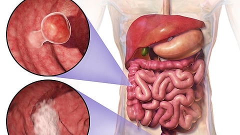 These findings are the first clinical trial results to validate previous observations that adjuvant anti-inflammatory prostaglandin inhibitors, such as celecoxib, improve survival for PIK3CA-mutated colon cancer. (Representational Image: Wikimedia Commons)