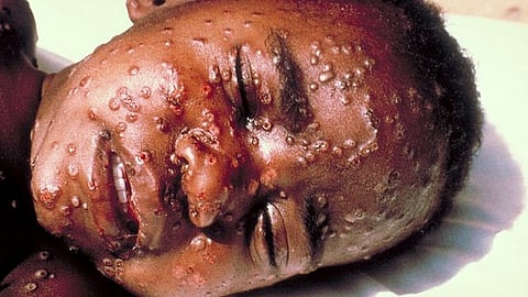 Two people have died after contracting mpox, or monkeypox, South African health authorities said Thursday. (Representational image: Wikimedia Commons)