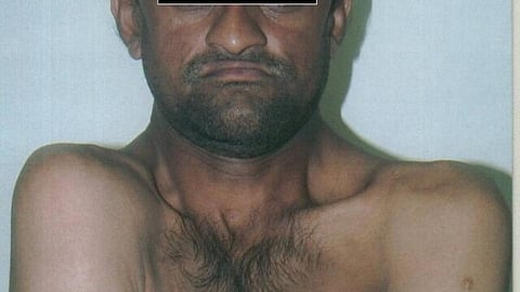 A patient with Cleidocranial Dysplasia (Representational image: Wikimedia Commons)