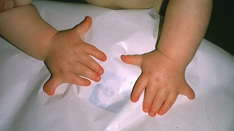 Born with 12 toes and 13 fingers, the baby has polydactyly, a rare condition where extra fingers or toes develop. (Representational image: Wikimedia Commons)