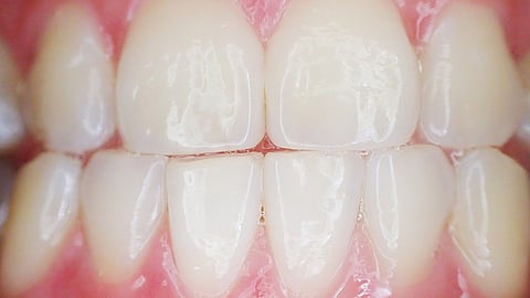 Periodontitis is a dental disease affecting most adults, which can result in the loss of teeth in severe conditions. (Representational Image- Pixabay)