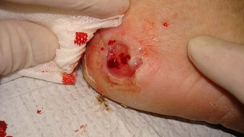 People with diabetes have an increased chance of developing foot sores known as Diabetic foot ulcers (Representational Image: Wikimedia Commons)