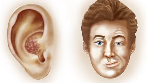 This picture depicts symptoms of Ramsay Hunt syndrome: facial paralysis and rashes due to damage to the facial nerve.