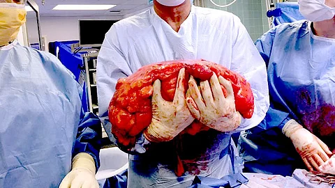 After investigating his case at the Sir Ganga Ram Hospital, it was revealed that he had a huge abdominal tumor (Representational image: Wikimedia Commons)