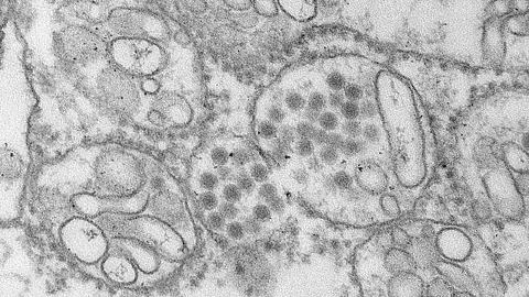 An electron microscopic image of Zika virus found in the cytoplasm of a neuron in a fetal brain.