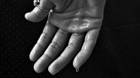 Hyperhidrosis is a condition with excessive sweating in the palms and other areas of the body. (Pixabay)