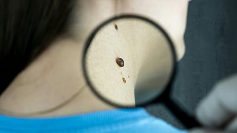 Brianna Solari, a nurse from California, was subjected to a harrowing experience with Southwest Airlines after undergoing surgery to reduce tumors caused by her neurofibromatosis (NF), a genetic disorder.
(Representational image: Unsplash)