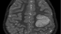 Step therapy, also referred to as “fail first,” requires a cancer patient to try a health plan preferred drug and have that drug fail them. (Representational Image: Wikimedia Commons)