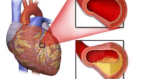 New discoveries in cardiac inflammation could lead to breakthroughs in preventing heart failure after a heart attack.(Wikimedia Commons)