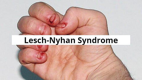 The painful realities of living with Lesch-Nyhan Syndrome. (Wikimedia Commons)