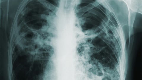 India introduced the BPaLM regimen for MDR-TB, which includes Bedaquiline, Pretomanid, Linezolid, and (with or without) Moxifloxacin. It is a newer, shorter regimen, often completed in less than 6 months. ( Representational image : Unsplash )