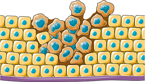 Age-related changes in the fibroblasts, cells that create the skin’s structure, contribute to the development of aggressive, treatment-resistant melanoma in males, according to research in mice (Representational Image-Wikimedia Commons)