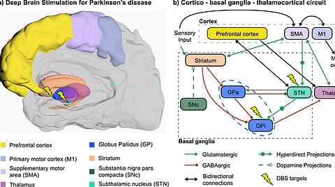A study led by researchers at (BIDMC) found the risk of developing Parkinson’s disease was 76 percent higher among those with a history of damage to the lining of their upper gastrointestinal (GI) tract than among those without. (Representational Image: Wikimedia Commons)