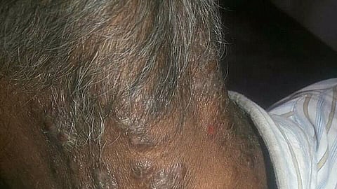 Scalp Psoriasis: Patches of the skin become scaly, itchy, painful and sometimes crack and bleed. (Representational Image: Wikimedia Commons)